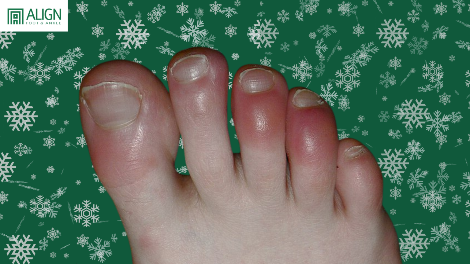 Raynaud’s vs. Chilblains: Understanding the Differences and How Dr. Ho ...