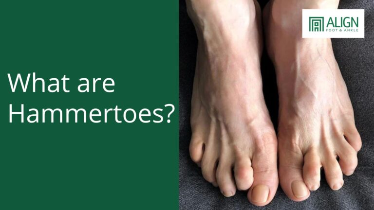 Understanding Hammertoes: A Common Foot Condition Explained