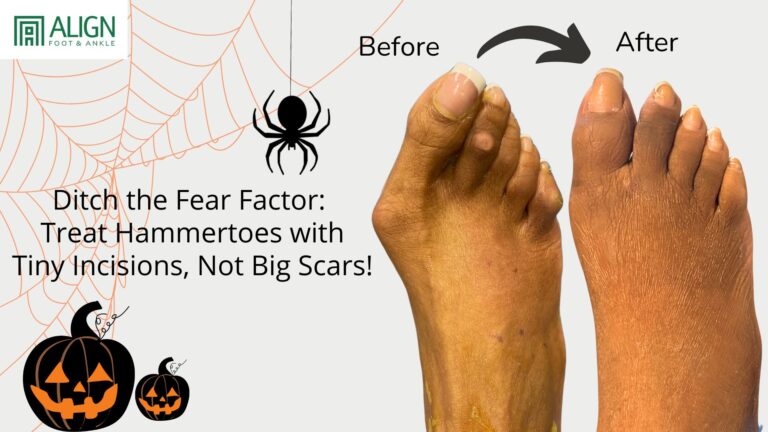 Ditch the Fear Factor: Treat Hammertoes with Tiny Incisions, Not Big Scars!