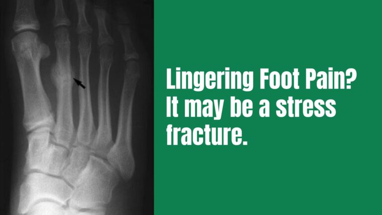 Lingering Foot Pain? It May Be a Stress Fracture