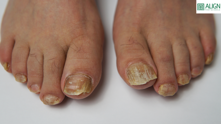 Toenail Fungus Truths: What Actually Works?