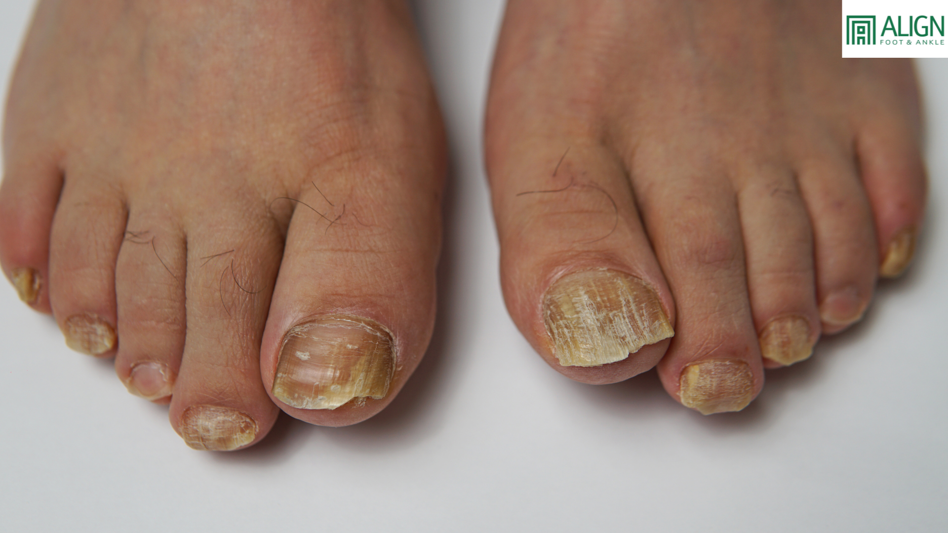 Toenail Fungus Truths: What Actually Works?